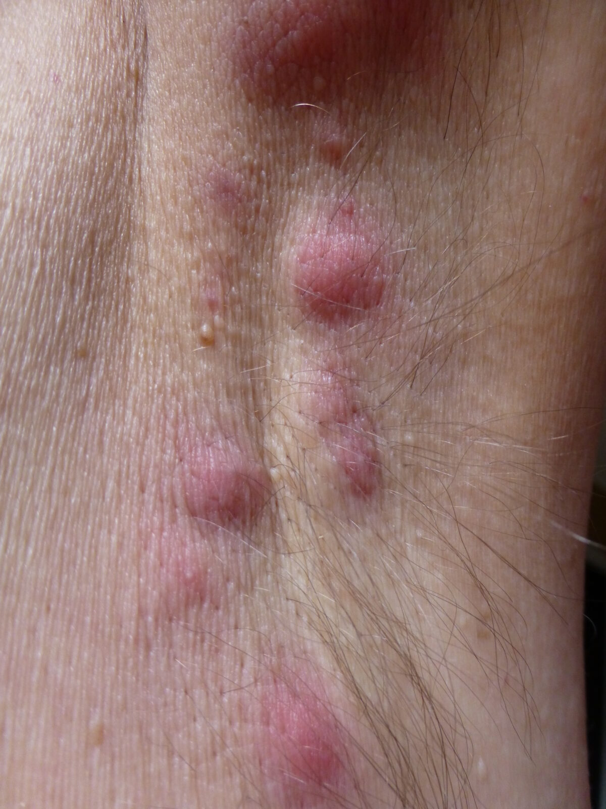 Acne inversa mit Entzündungen in der Achsel