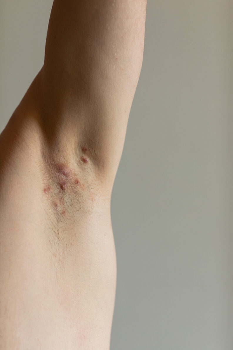 Acne inversa: Narben und Knötchen in der Achsel