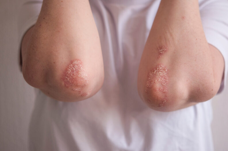 Schuppige Psoriasis-Plaques am Ellenbogen eines jungen Mannes